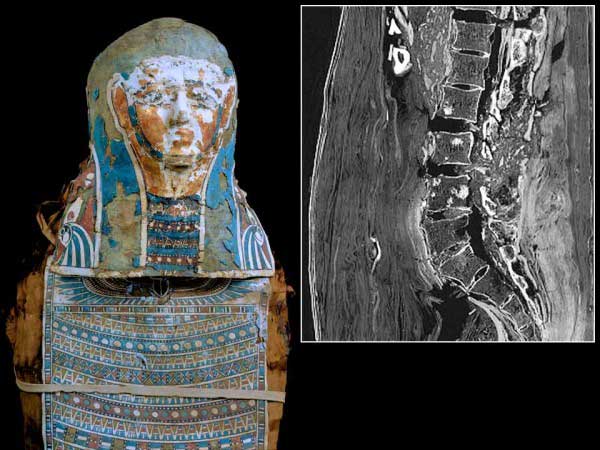 El caso más antiguo de metástasis en cáncer de próstata, detectada en una momia de 2.700 años